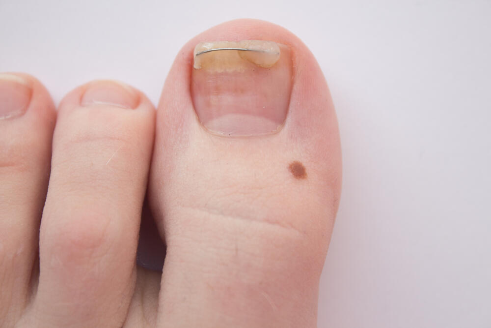 Nail figure, ingrown nail, onychocryptosis. toenail clamp on an ingrown toenail